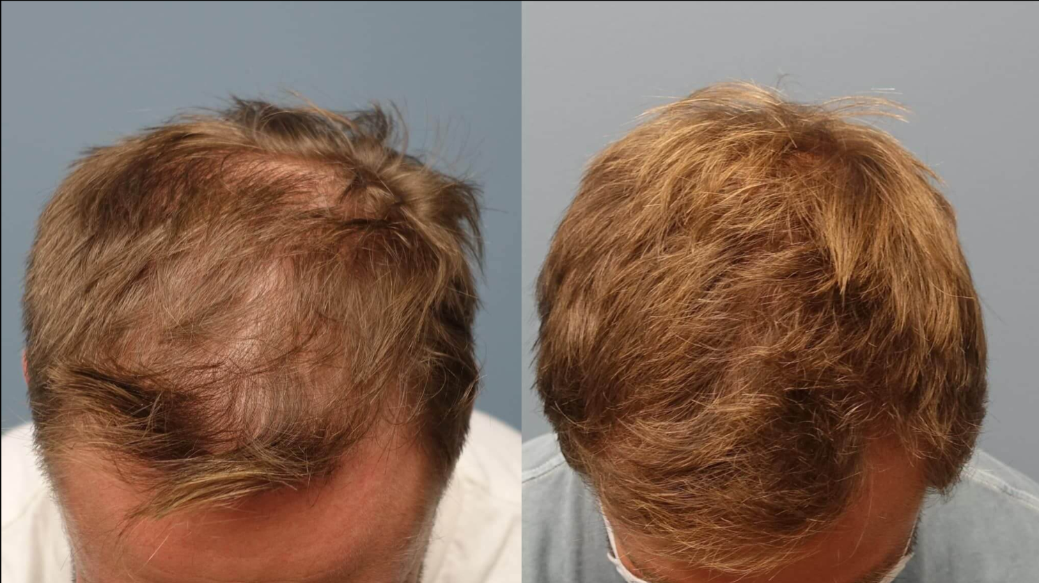 Two side-by-side scalp photos showing thinning hair from the top Two side-by-side scalp photos showing thinning hair from the top