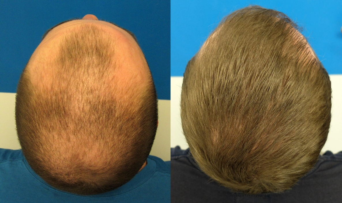 Top and rear views of a balding scalp showing significant hair thinning and hair around the sides. Top and rear views of a balding scalp showing significant hair thinning and hair around the sides.
