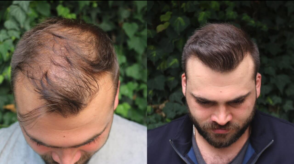 Top-down view of two men outdoors, both looking down with visible thinning hairlines. Top-down view of two men outdoors, both looking down with visible thinning hairlines.