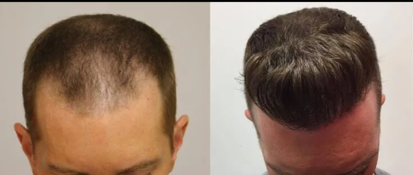 Two side-by-side top-down scalp photos showing thinning hair before and after treatment Two side-by-side top-down scalp photos showing thinning hair before and after treatment