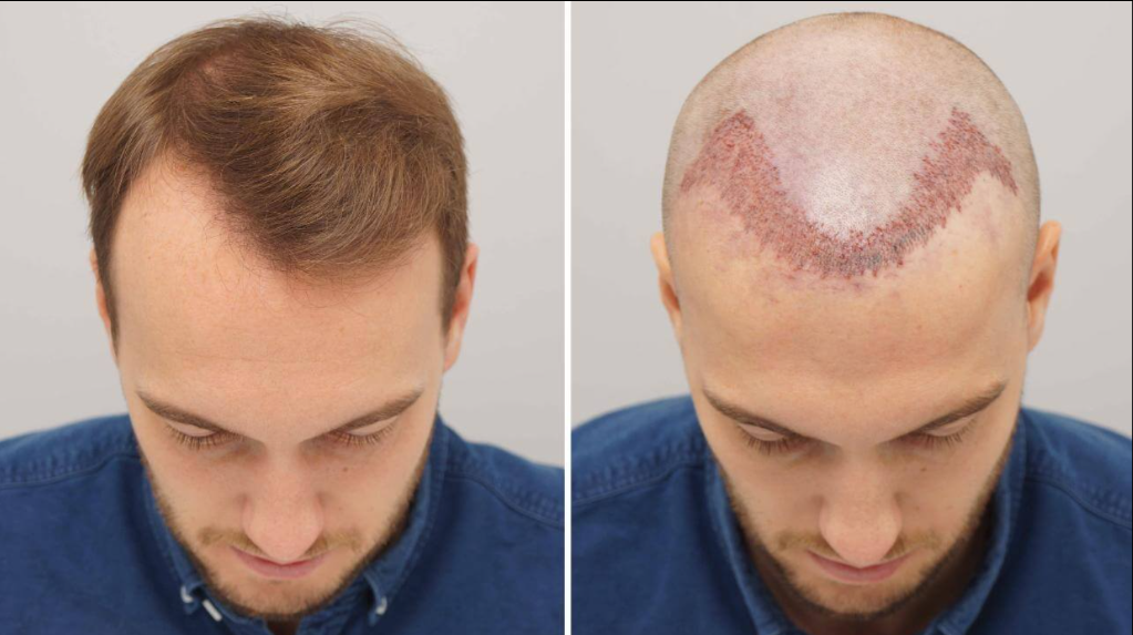 Top-down comparison of a man’s scalp before and after hair loss treatment, with hair restored in a heart shape. Top-down comparison of a man’s scalp before and after hair loss treatment, with hair restored in a heart shape.