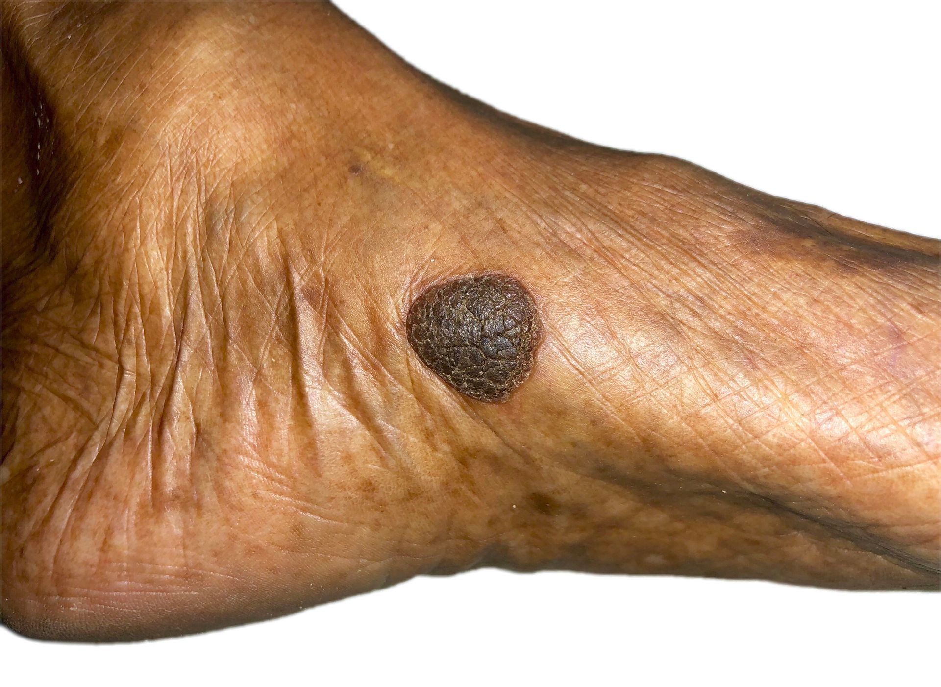 A person is holding their ankle in pain.