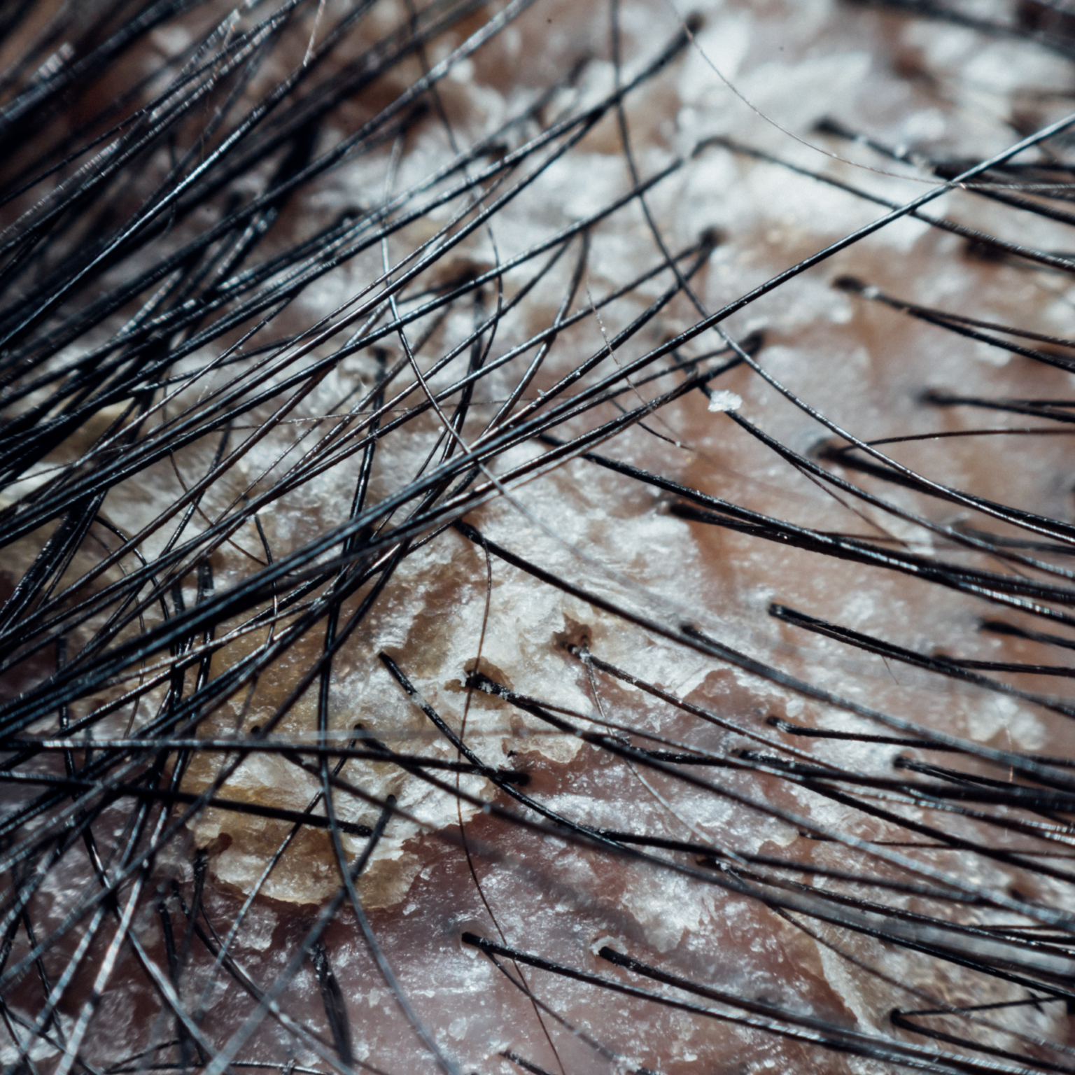 A close up of a person 's hair with dandruff.