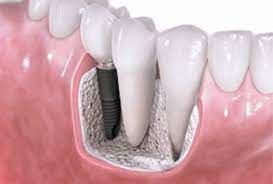 Un primer plano de un diente con un implante dental.