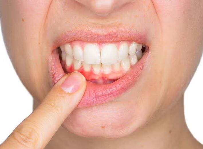 Periodoncia