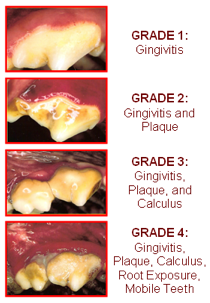 four pictures of teeth showing different stages of gingivitis