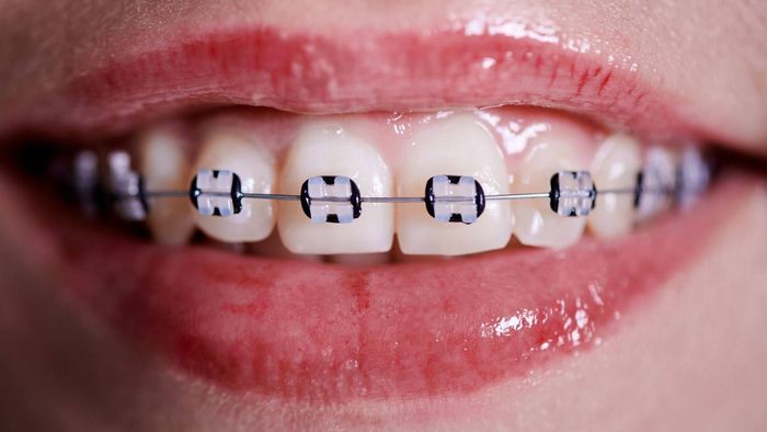 Un primer plano de la boca de una mujer con aparatos dentales en los dientes.