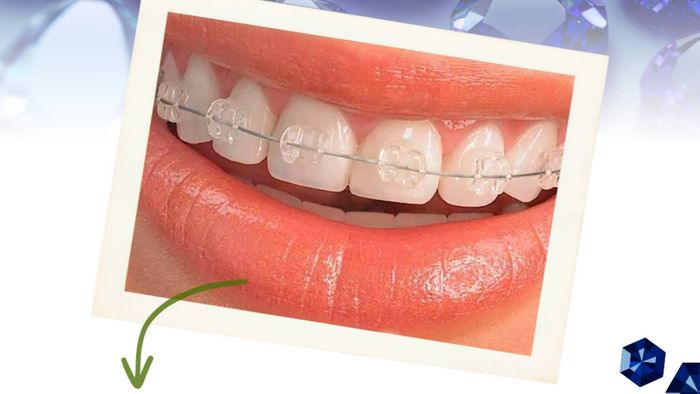 Una mujer con aparatos ortopédicos se hace examinar los dientes por un dentista.