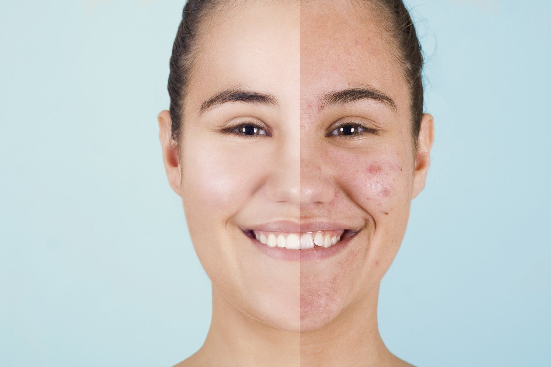 Woman's face split: left side shows clear skin; right side shows acne-prone skin. She smiles.