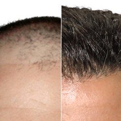 Before and After ARTAS — Fort Gratiot, MI — Hamzavi Dermatology & Dermatology Specialists Before and After ARTAS — Fort Gratiot, MI — Hamzavi Dermatology & Dermatology Specialists