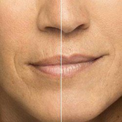 Before and After Belotero — Fort Gratiot, MI — Hamzavi Dermatology & Dermatology Specialists Before and After Belotero — Fort Gratiot, MI — Hamzavi Dermatology & Dermatology Specialists
