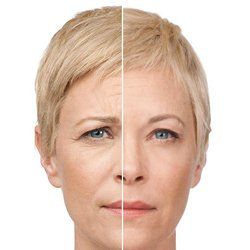 Before and After Botox — Fort Gratiot, MI — Hamzavi Dermatology & Dermatology Specialists Before and After Botox — Fort Gratiot, MI — Hamzavi Dermatology & Dermatology Specialists