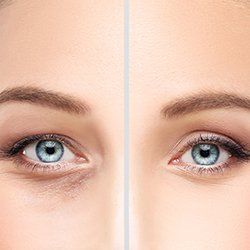 Before and After Eyelid Lift — Fort Gratiot, MI — Hamzavi Dermatology & Dermatology Specialists Before and After Eyelid Lift — Fort Gratiot, MI — Hamzavi Dermatology & Dermatology Specialists