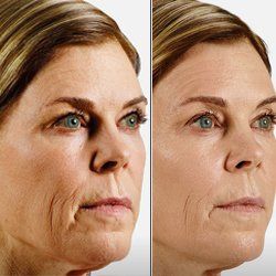Before and After Juvederm — Fort Gratiot, MI — Hamzavi Dermatology & Dermatology Specialists Before and After Juvederm — Fort Gratiot, MI — Hamzavi Dermatology & Dermatology Specialists