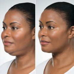 Before and After Kybella — Fort Gratiot, MI — Hamzavi Dermatology & Dermatology Specialists Before and After Kybella — Fort Gratiot, MI — Hamzavi Dermatology & Dermatology Specialists