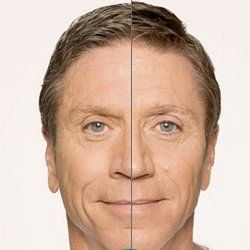 Before and After Radiesse — Fort Gratiot, MI — Hamzavi Dermatology & Dermatology Specialists Before and After Radiesse — Fort Gratiot, MI — Hamzavi Dermatology & Dermatology Specialists