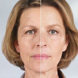 Before and After Sculptra — Fort Gratiot, MI — Hamzavi Dermatology & Dermatology Specialists Before and After Sculptra — Fort Gratiot, MI — Hamzavi Dermatology & Dermatology Specialists