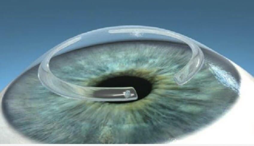 OPTILÁSER - CIRUGIA OCULAR