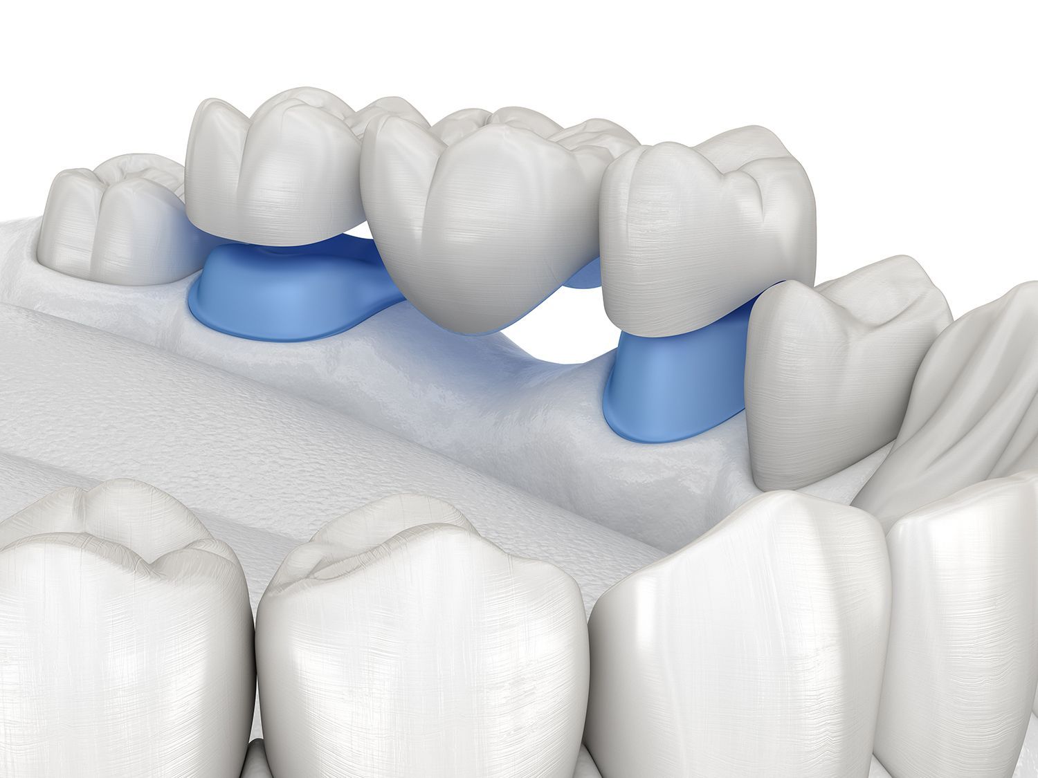 A computer generated image of a dental bridge between two teeth.
