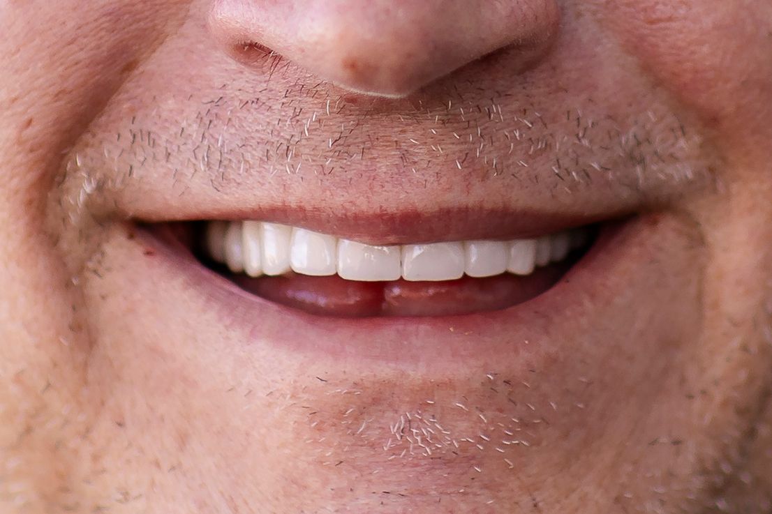 Close up of a man's mouth after dental implant procedure