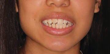 Close up of a woman's smile before cosmetic dental procedures