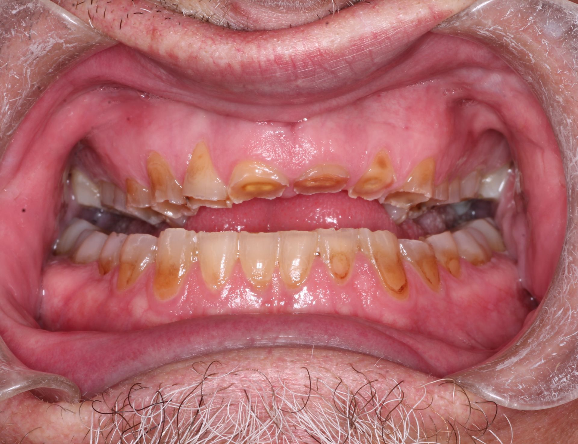 Close up of a man's mouth before dental implant procedure