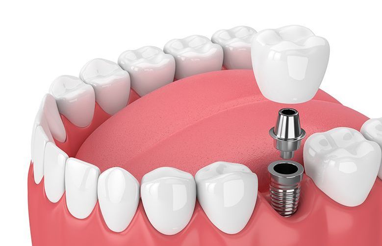A close up of a tooth with a dental implant in it.