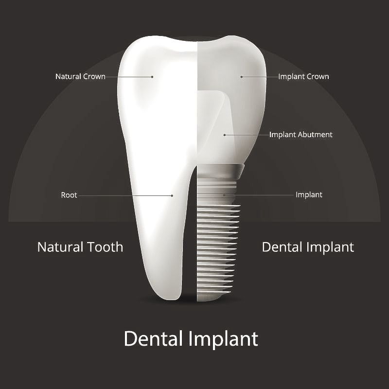 A diagram showing the difference between a natural tooth and a dental implant.