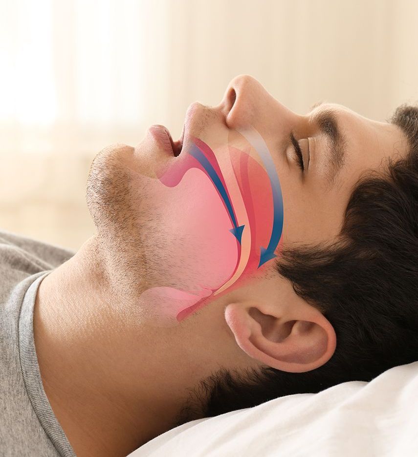 A man is laying on a bed with his mouth open and a diagram of his airway.