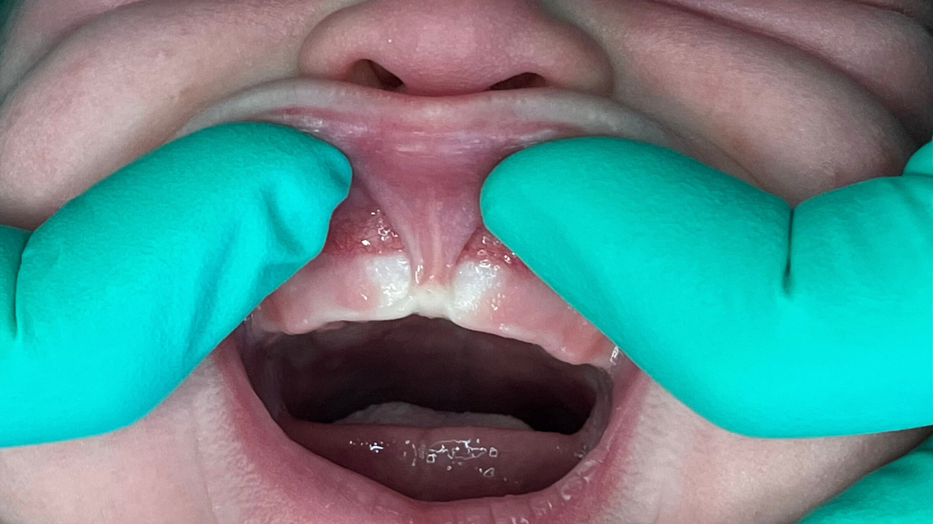 A close up of a baby 's mouth with green gloves on.
