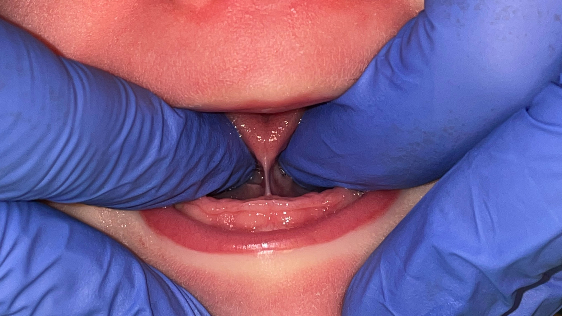 A person wearing blue gloves is examining a baby 's teeth.