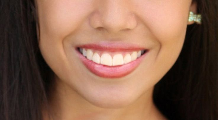 Close up of a woman's smile after cosmetic dental procedures