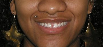 Close up of a woman's smile before cosmetic dental procedures