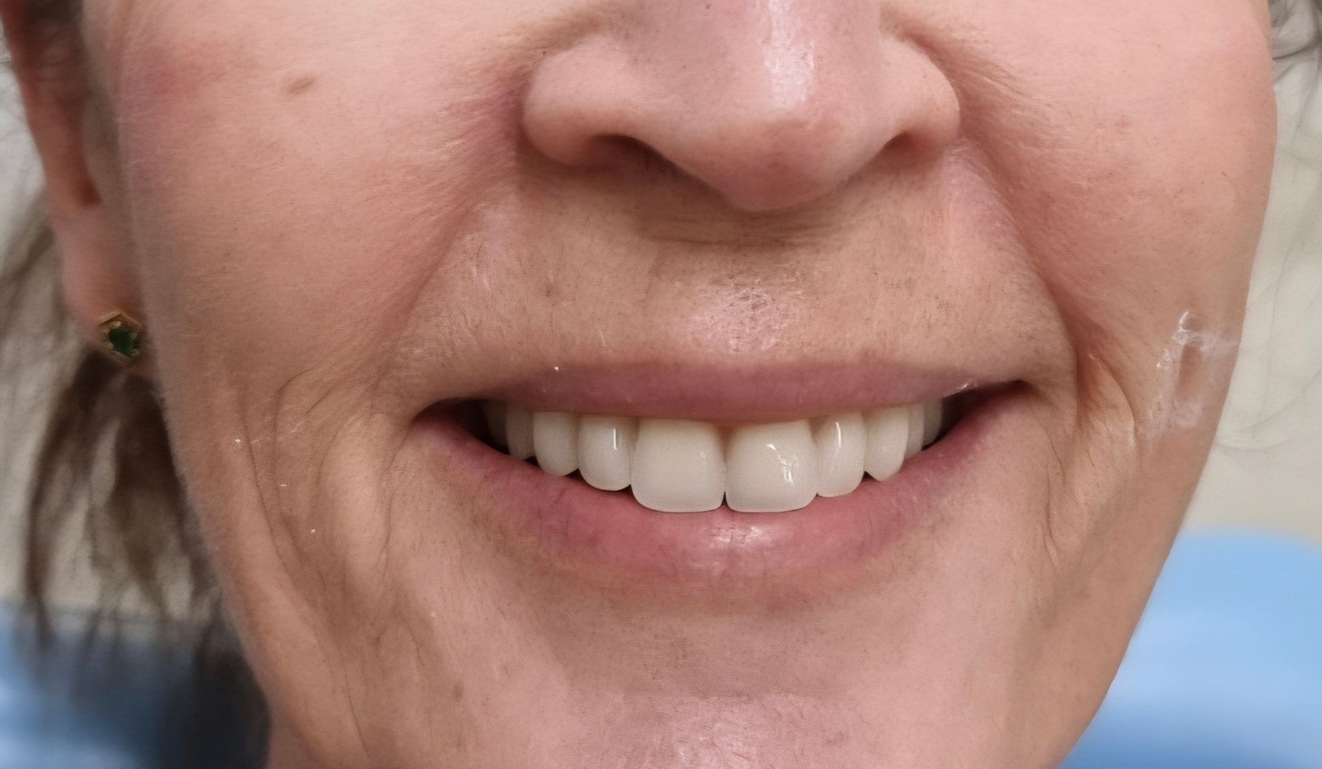 A close up of a lady with a big smile showing teeth — Smiles on Hudson In Hamilton, NSW
