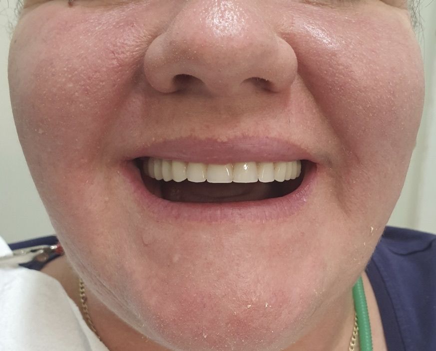 Close-up of a Smiling Older Woman's Face Showing New, Straight Teeth — Smiles on Hudson In Hamilton, NSW

