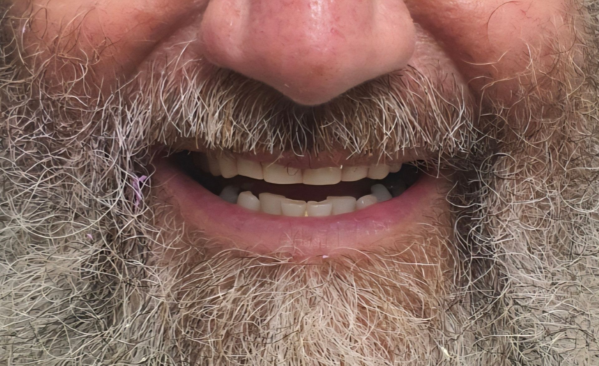 Close-up of a Smiling Older Woman's Face Showing New, Straight Teeth — Smiles on Hudson In Hamilton, NSW
