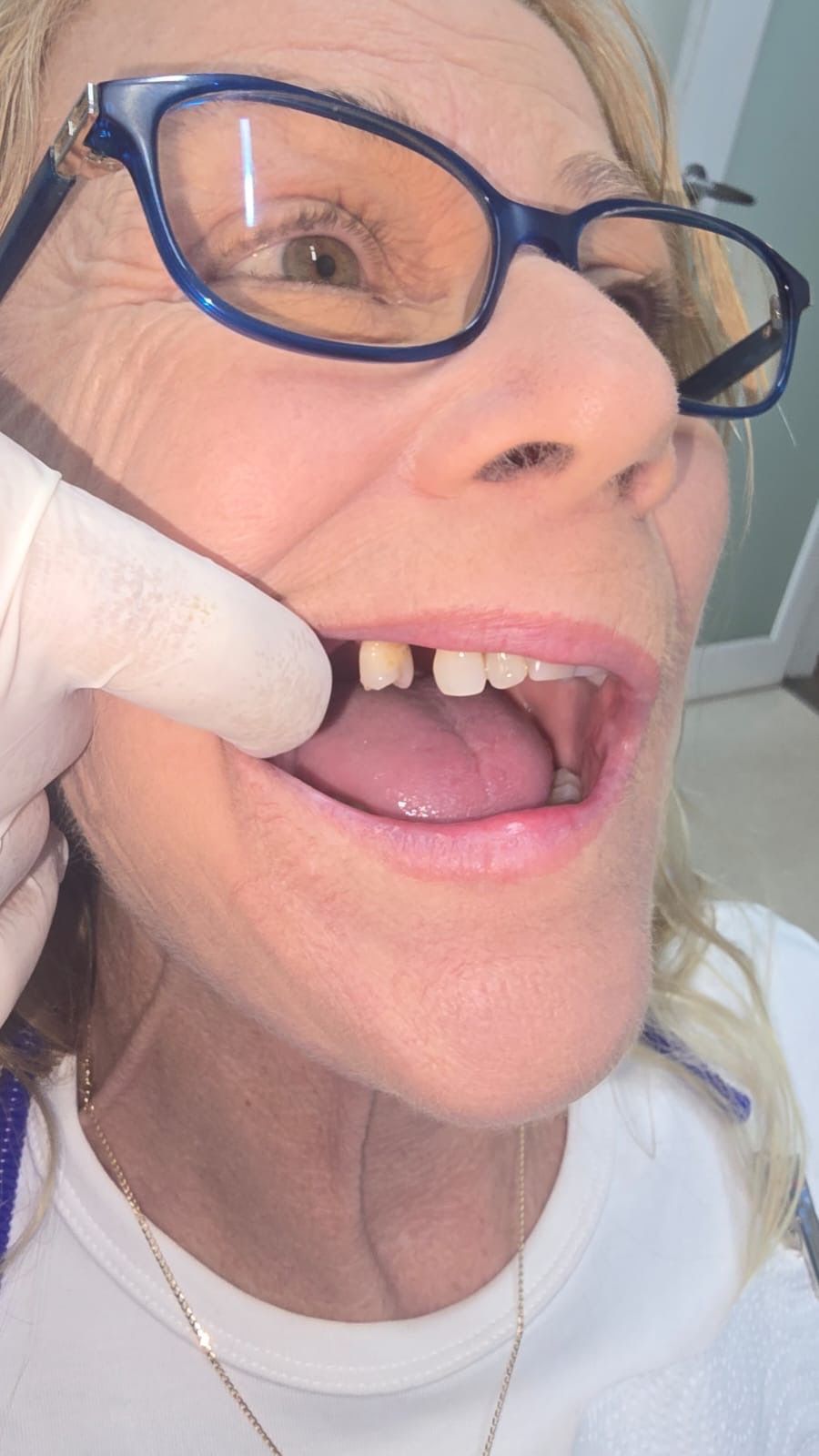 A gloved hand retracts the upper lip of a person, revealing a prepared tooth stump for a dental crown — Smiles on Hudson In Hamilton, NSW