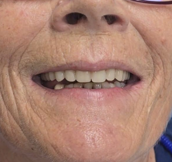 Close-up of Older Woman's Face, Smiling, Showing White Teeth — Smiles on Hudson In Hamilton, NSW
