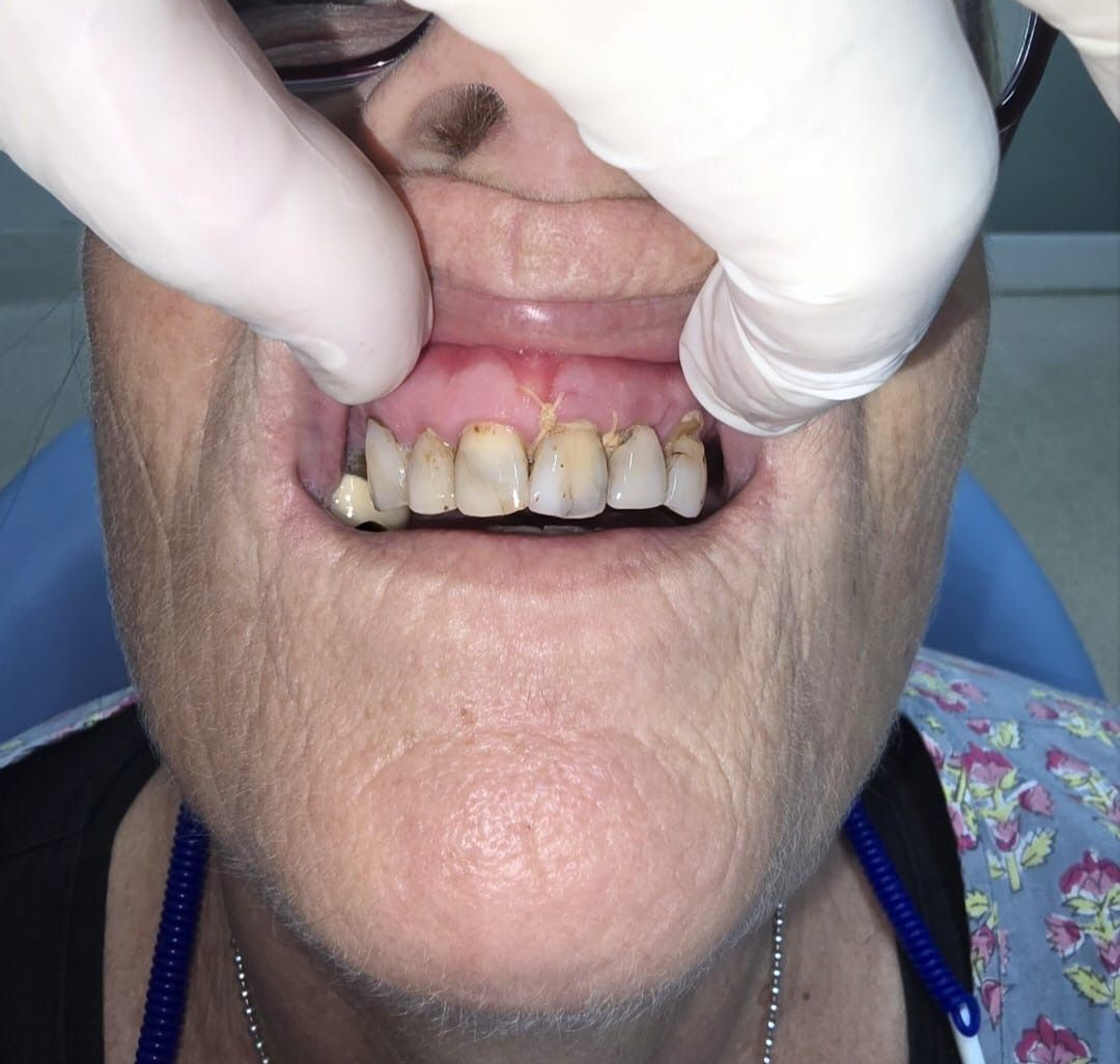 Smiling Person With Light Skin, Showing Teeth With Gold Adornments — Smiles on Hudson In Hamilton, NSW
