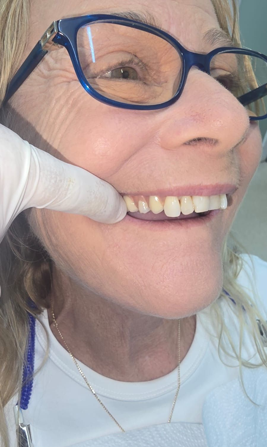 A gloved finger gently lifts a person's upper lip to reveal their teeth and gums in a dental setting— Smiles on Hudson In Hamilton, NSW