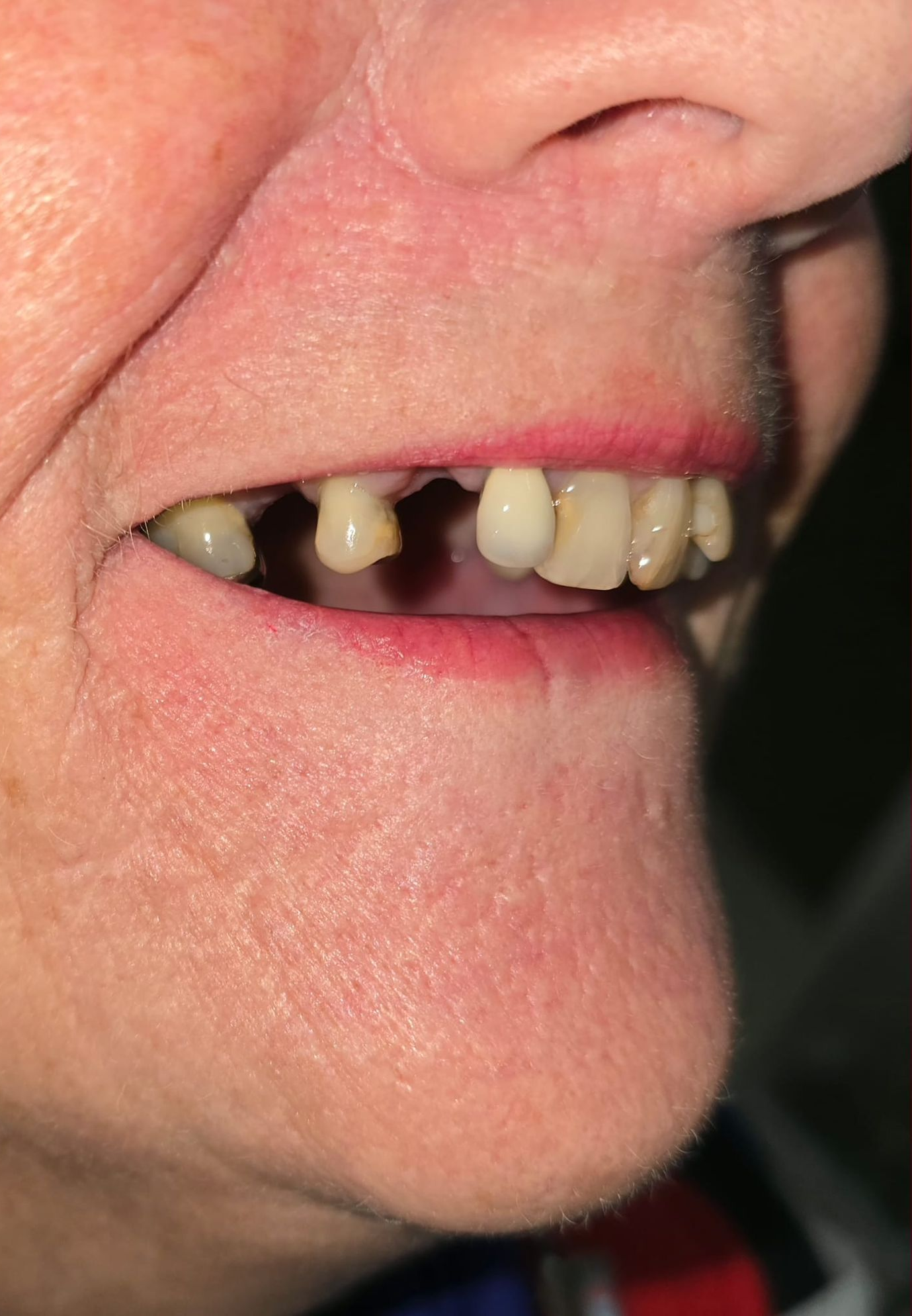 Smiling Person With Light Skin, Showing Teeth With Gold Adornments — Smiles on Hudson In Hamilton, NSW
