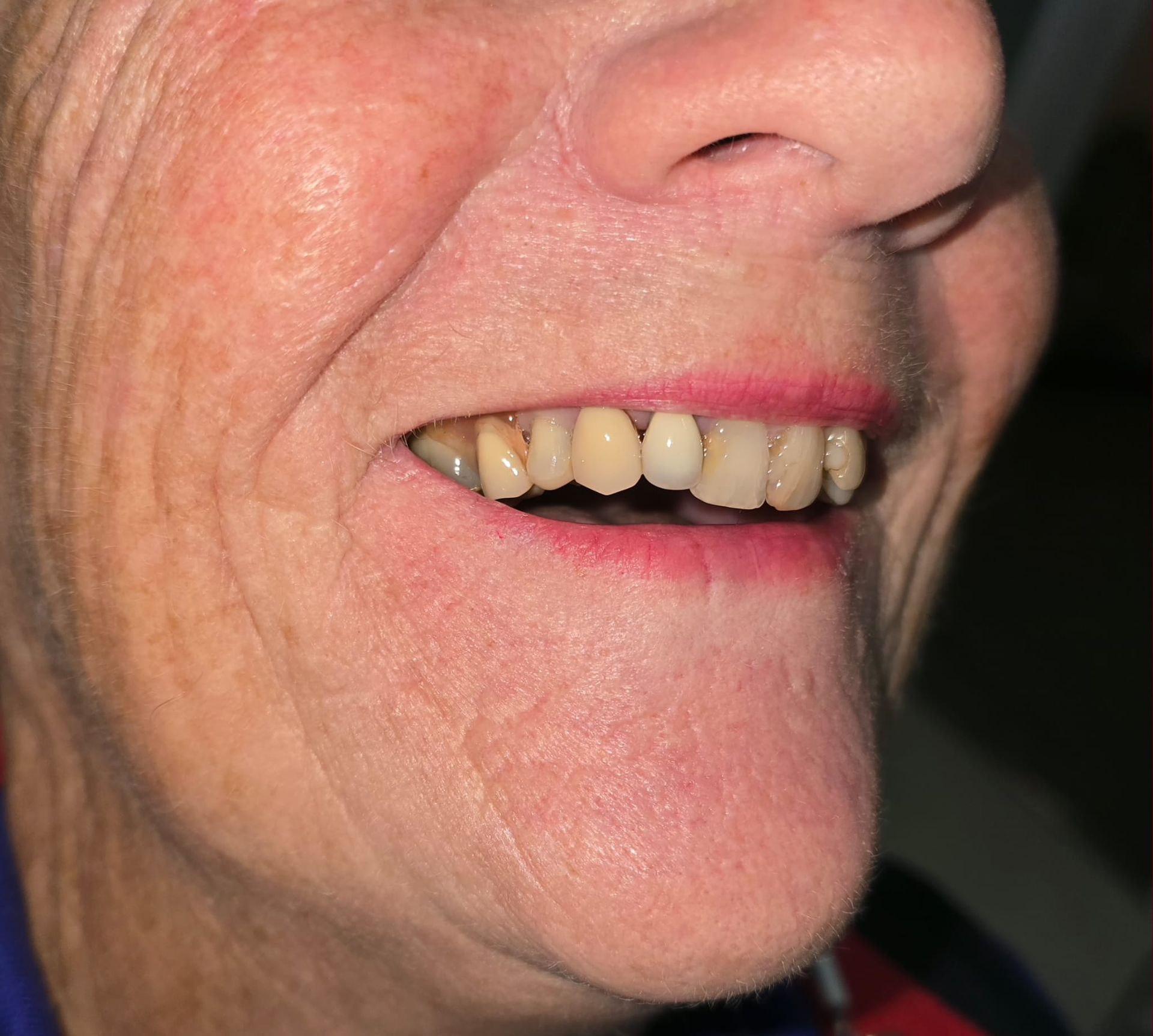 Close-up of Older Woman's Face, Smiling, Showing White Teeth — Smiles on Hudson In Hamilton, NSW
