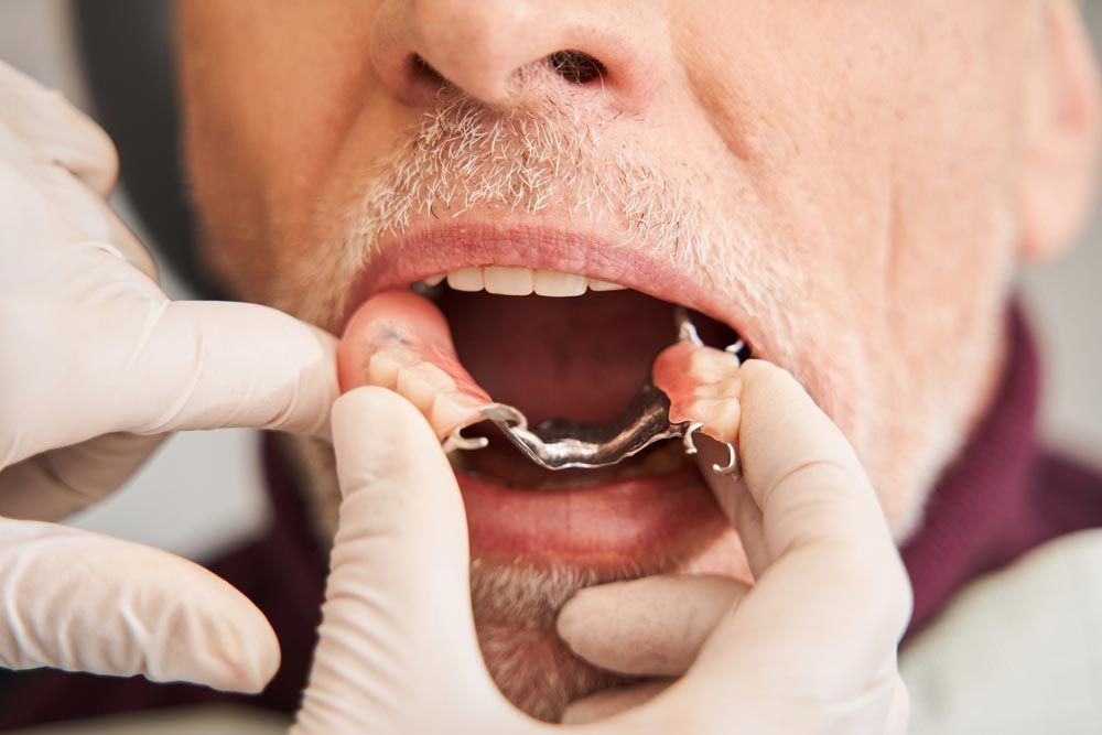 A Dentist Putting in a Partial Denture Into a Man's Mouth — Smiles on Hudson In Hamilton, NSW
