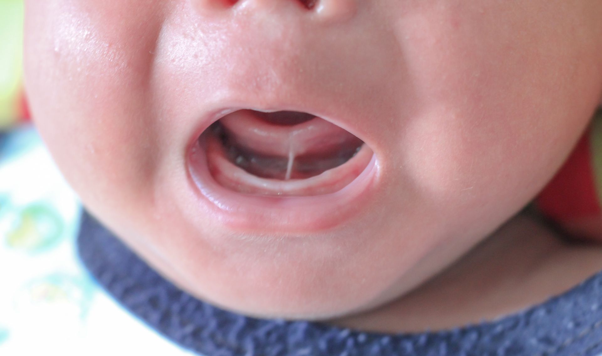 Baby's mouth open, tongue tied to the bottom of the mouth by a frenulum.