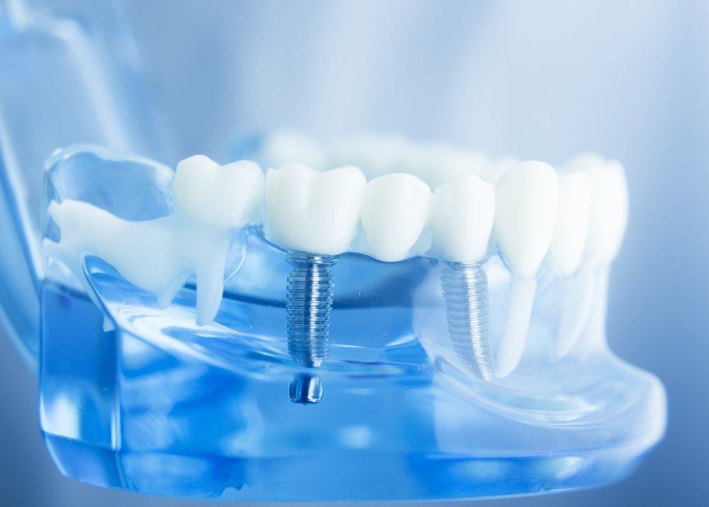 A close up of a model of a dental implant in a mouth.