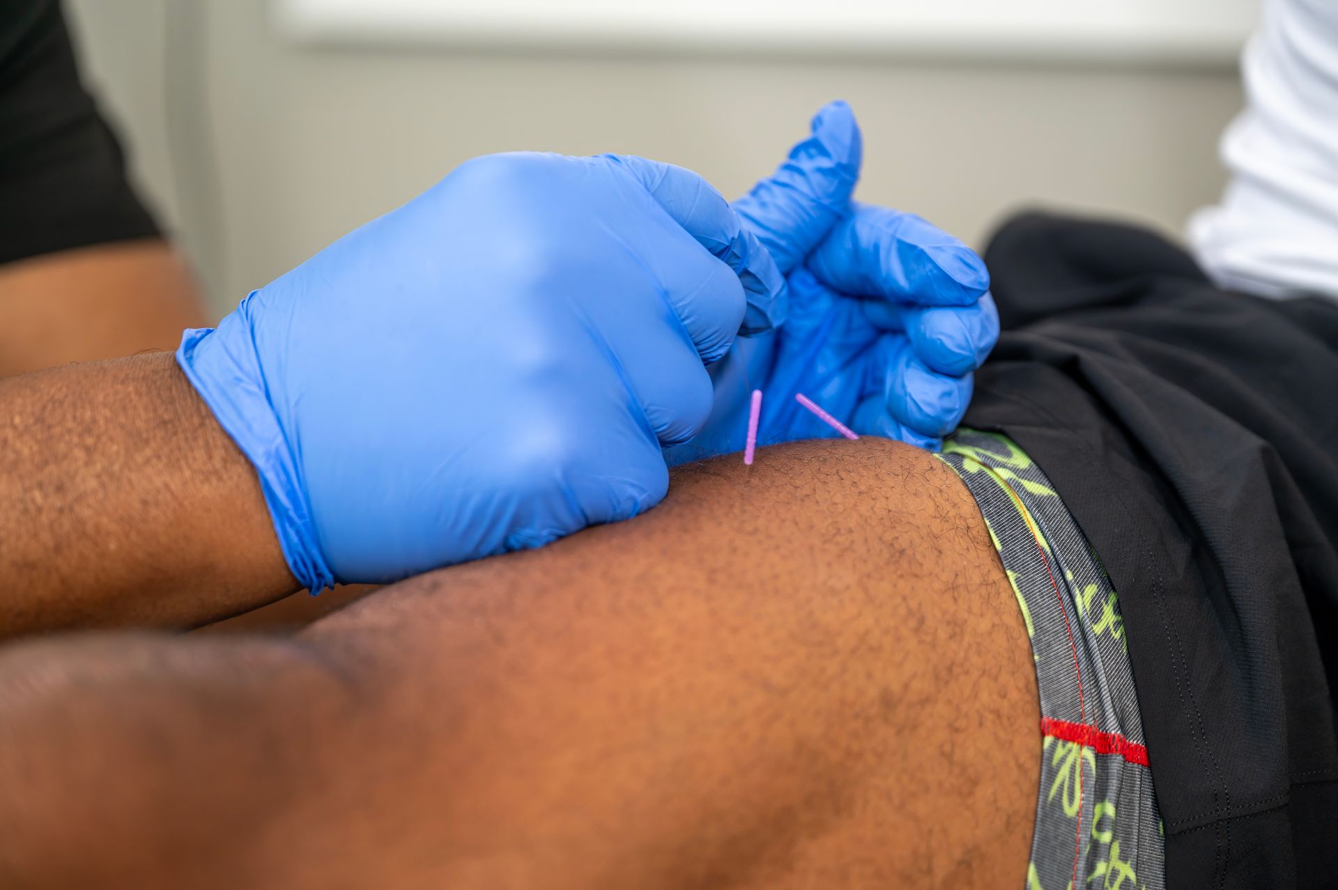 Dry Needling Near Me Find Relief For Chronic Pain