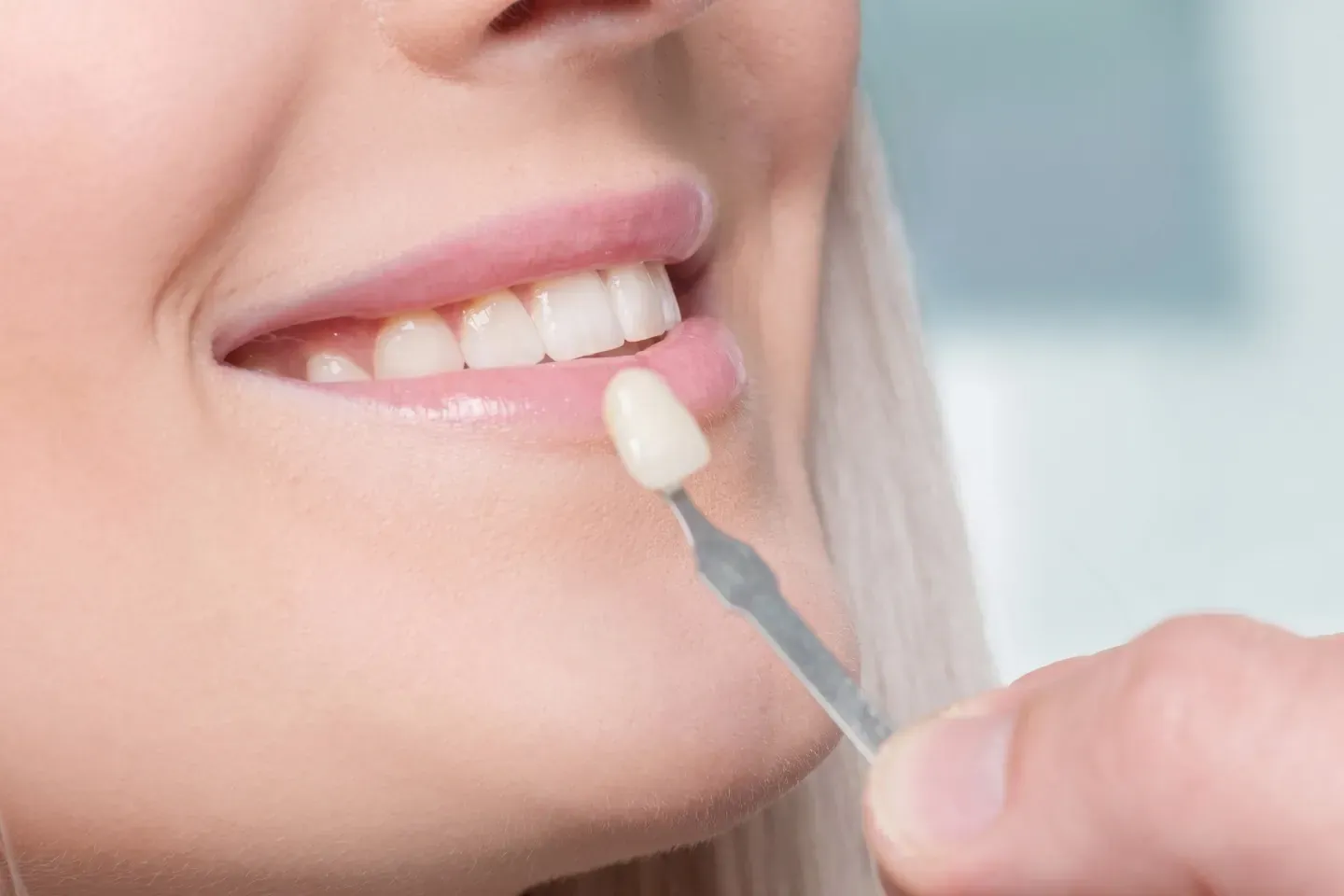 No Prep Veneers in Delray beach