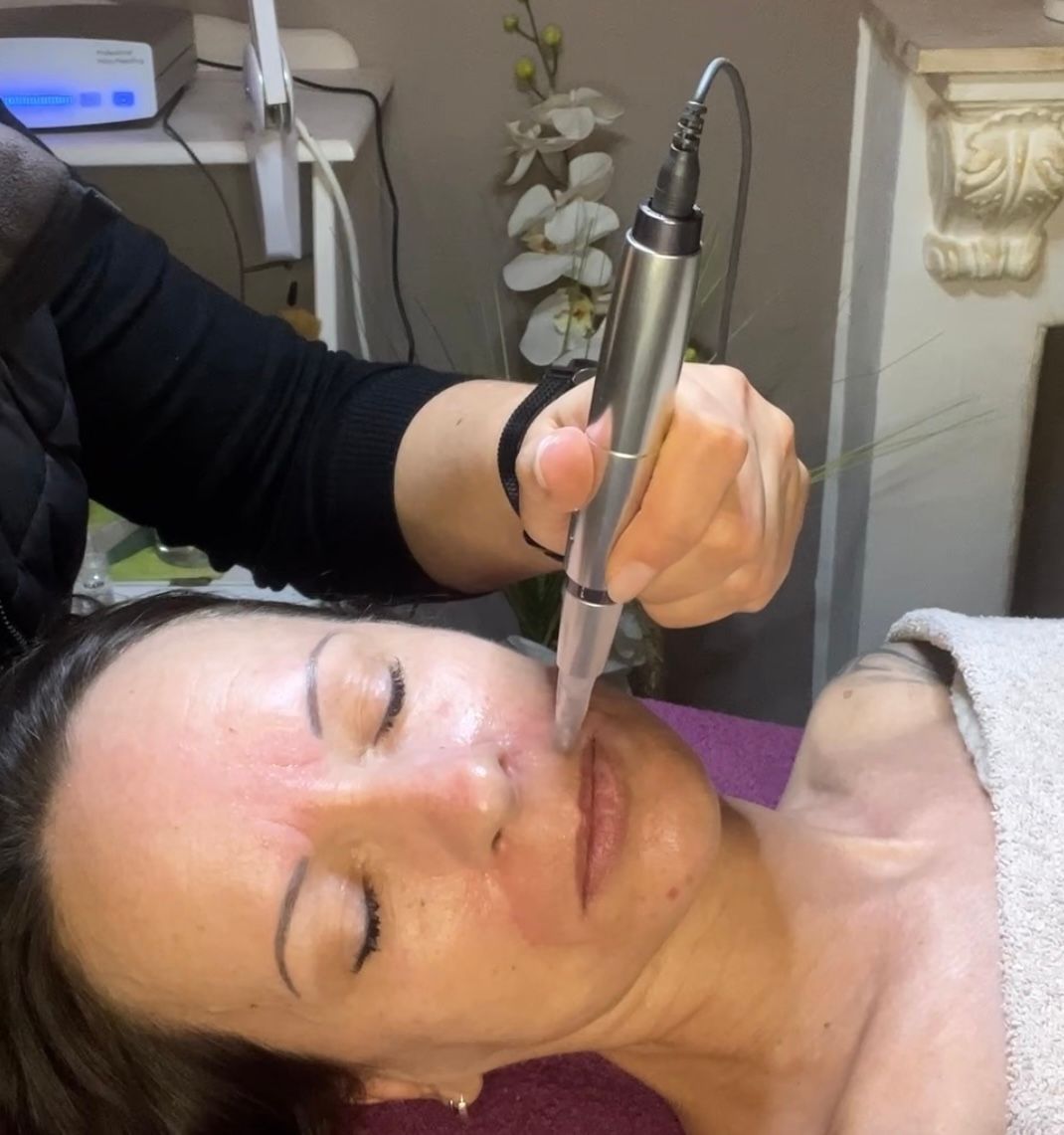 Microneedling