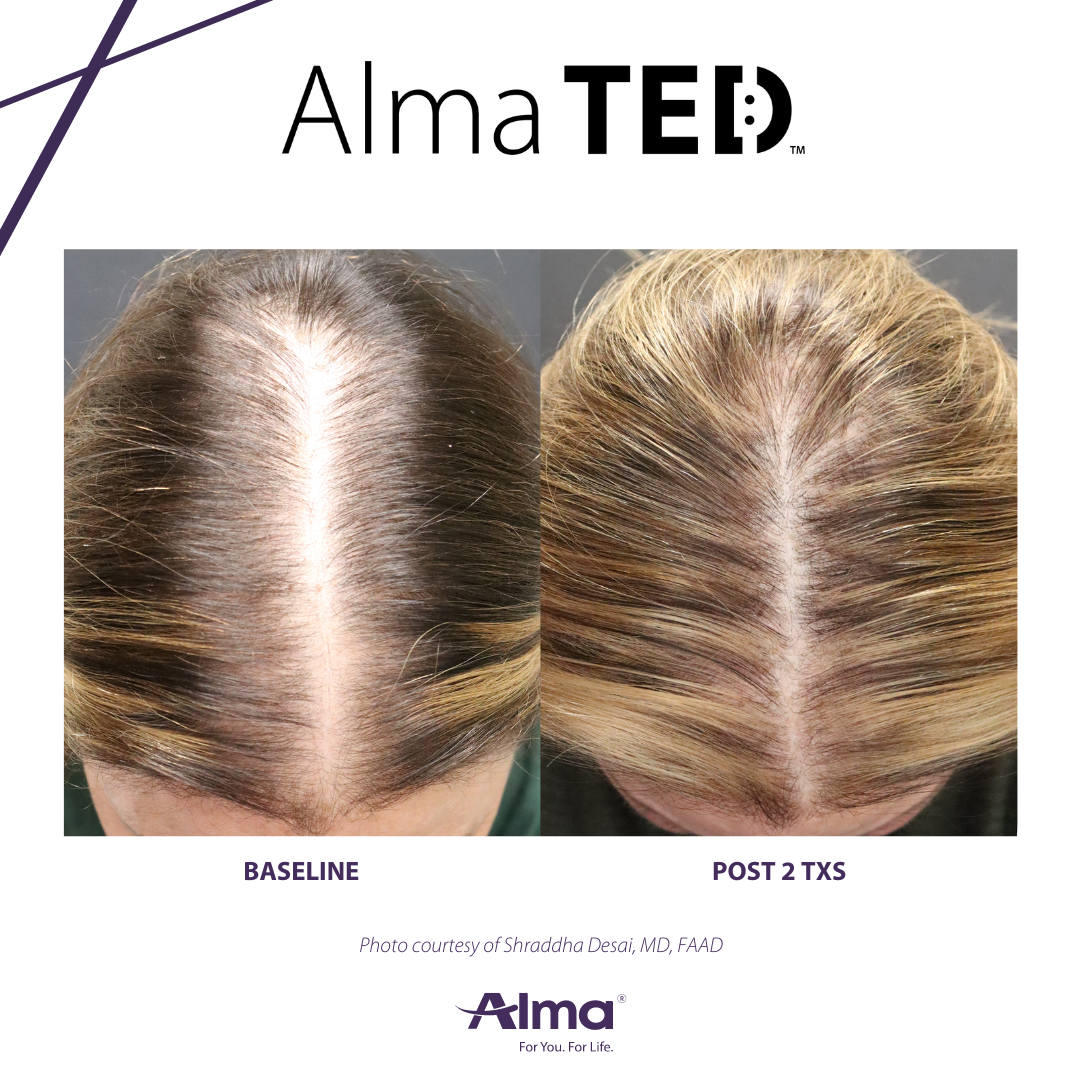 Ted Protocol TED Hair Restoration