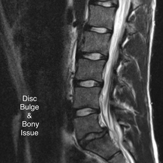 Disc bulge diagram